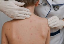 Colima 2do Lugar Nacional en Incidencia de Sarampión