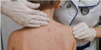 Colima 2do Lugar Nacional en Incidencia de Sarampión