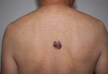Impulsa IMSS Colima la Detección Oportuna y Cuidado de la Piel ante el Melanoma