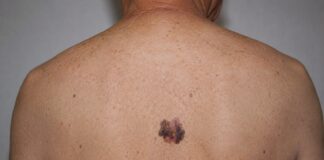 Impulsa IMSS Colima la Detección Oportuna y Cuidado de la Piel ante el Melanoma